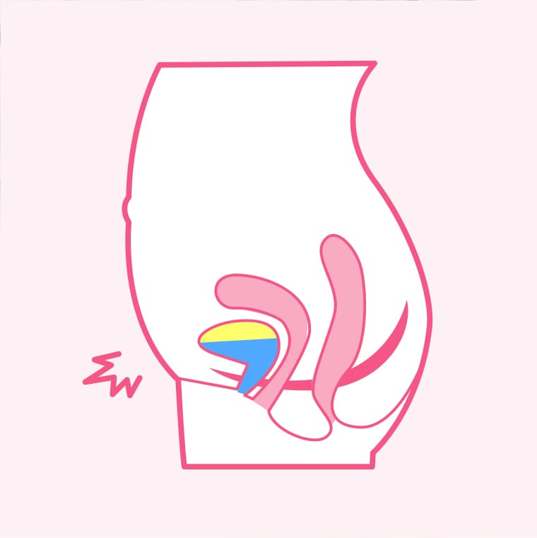 女性の尿モレの主な原因